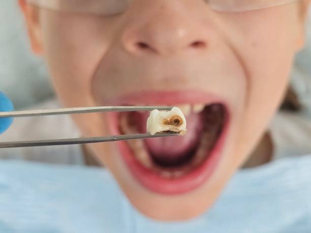 Best Dental Abscess Treatment in Ellitt, CO